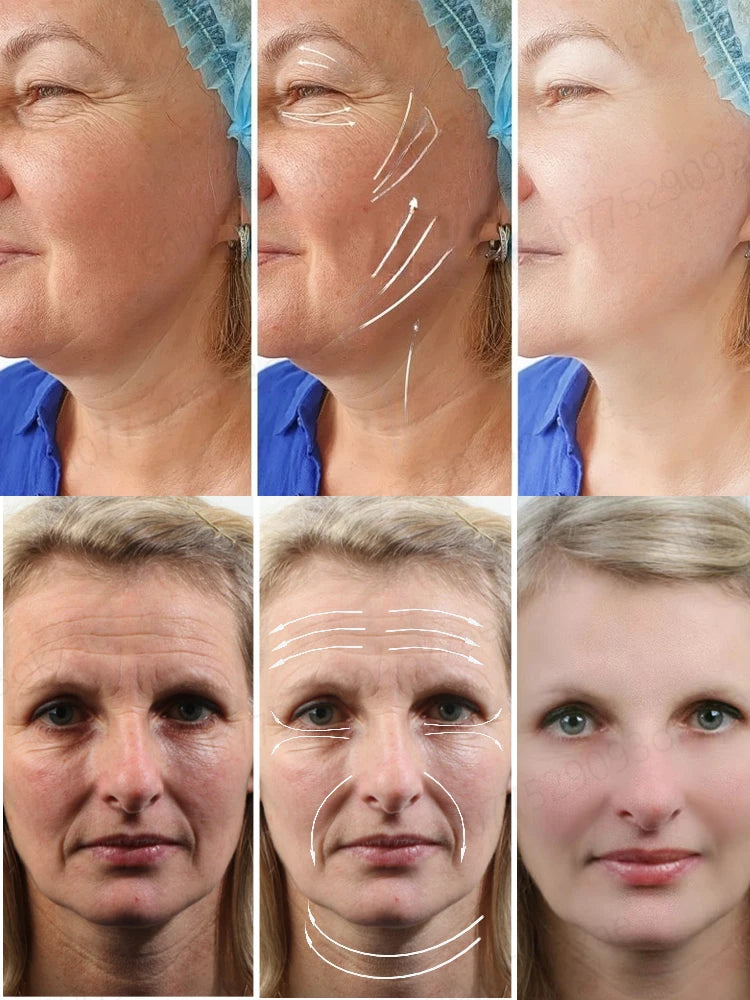 Anti Wrinkle Aging Instant Effect Remove Facial Wrinkles